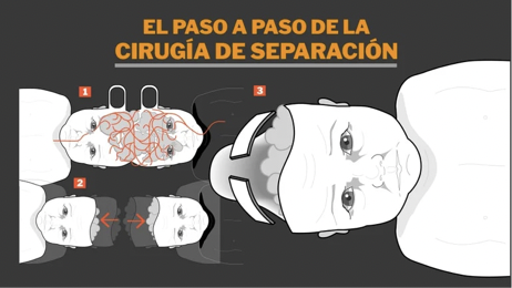 Gemelos unidos por la cabeza fueron separados por médicos que se entrenaron con realidad virtual